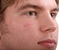 facial scarring compensation Facial scarring compensation
